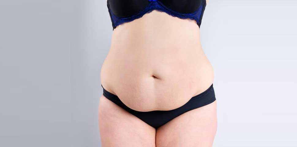 Gastric Sleeve
