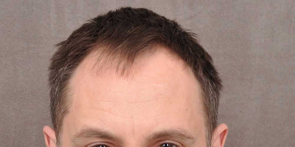 Hair Transplant